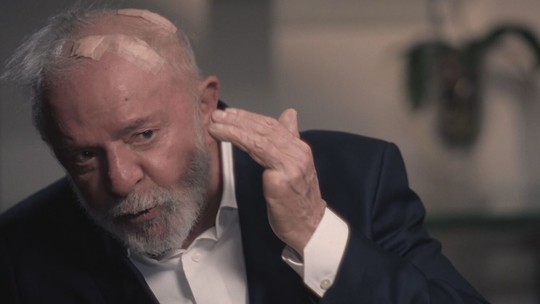 Lula diz que está com furos na cabeça e mostra curativos - Foto: (Reprodução/Globo)