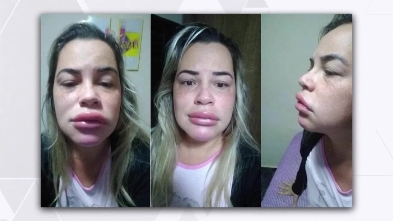 Vítima de uso de PMMA diz que boca inchou do dia para noite: 'Parecia que ia explodir'