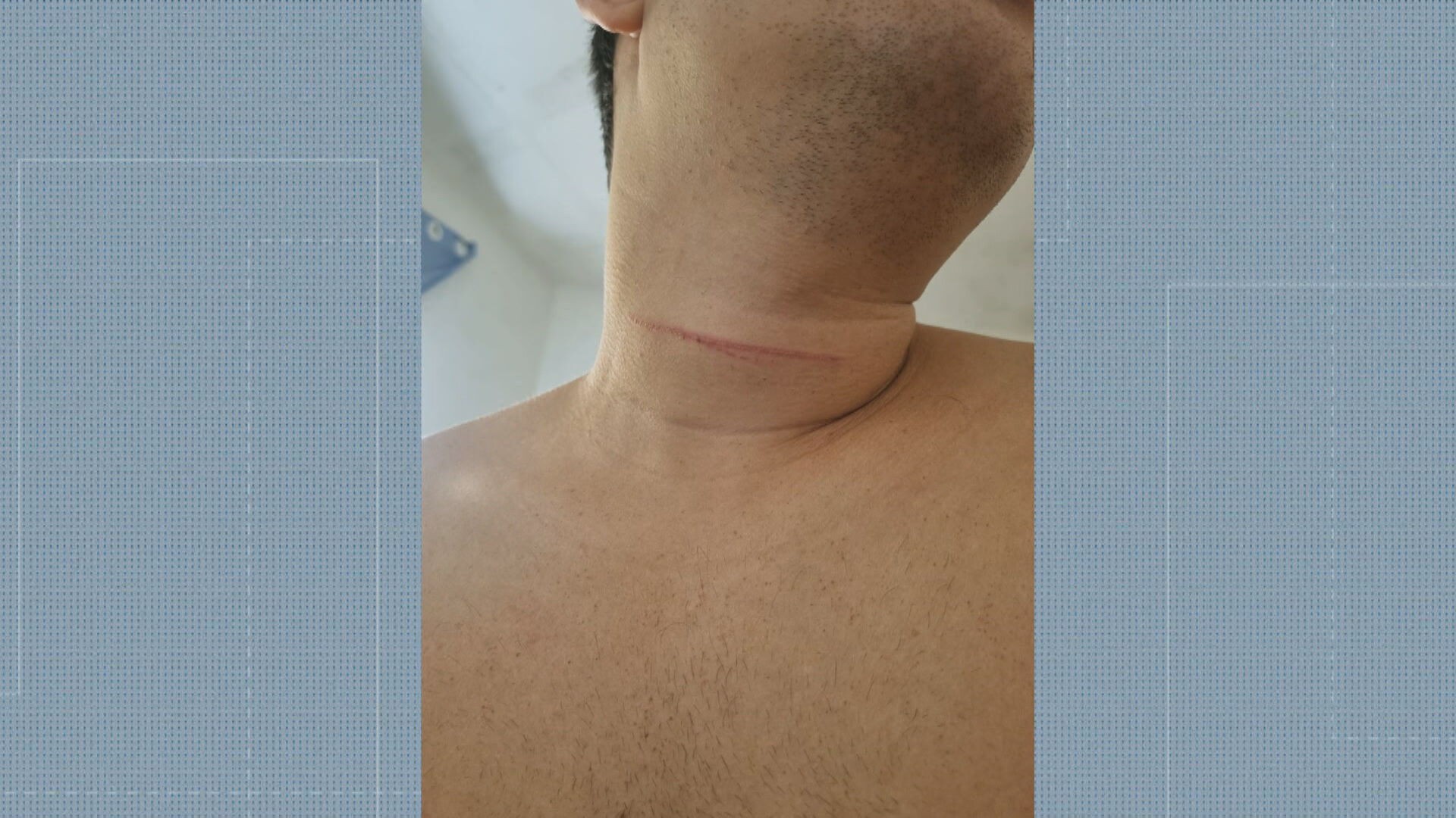 Motoboy tem pescoço cortado e consegue escapar de corte profundo após arrancar linha chilena com as mãos