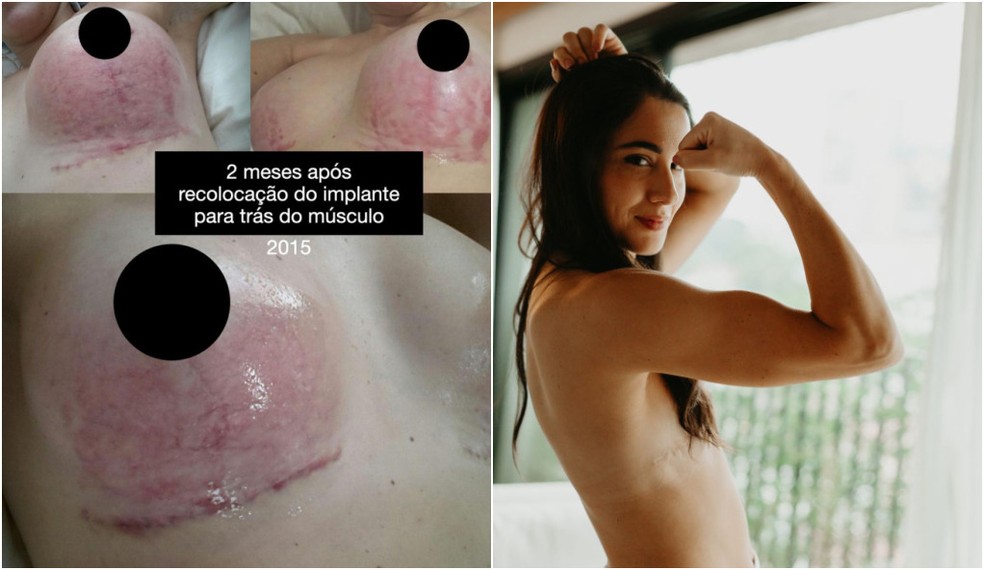 Mariana Forti fez nova cirurgia para reposicionar o implante, mas a inflamação voltou com mais força. — Foto: Arquivo Pessoal
