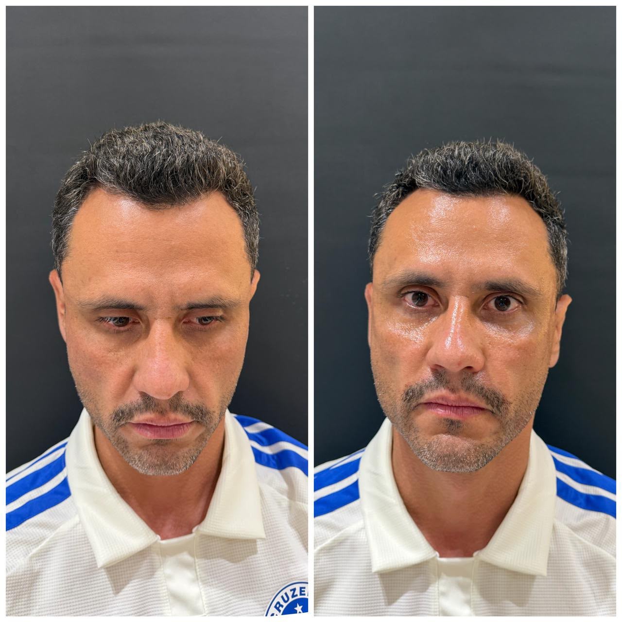 Cleitinho, governador eleito de MG, faz harmonização facial: 'Sinais de cansaço'; VÍDEO