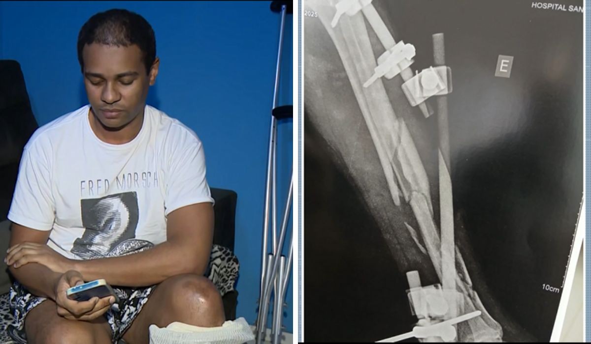'Em segundos, muda a vida toda': vítima de atropelamento deve ficar em recuperação por 1 ano 