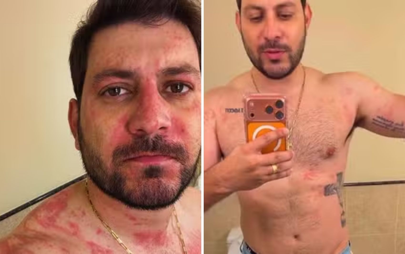 Ex-BBB Caio Afiune comenta susto com crise alérgica: 'Não travou o Bastião' 