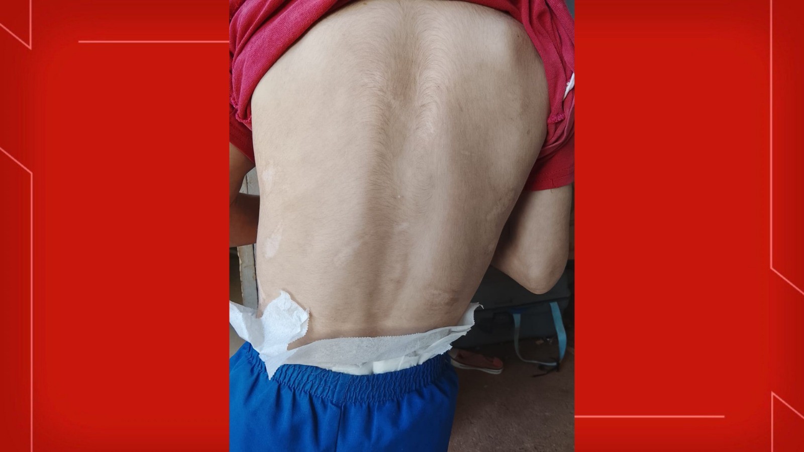 Agressões e queimaduras com garfo quente: criança de 8 anos é vítima de maus-tratos no DF; madrasta é a principal suspeita
