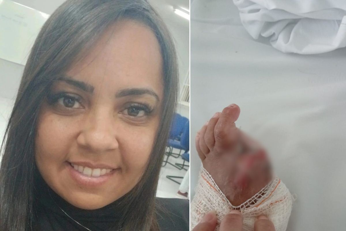 Mulher atropelada por caminhoneiro bêbado viu o namorado morrer, amputou o dedo e teme perder o pé: 'Não quero perder mais'