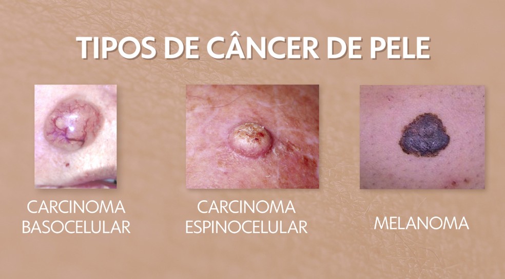 Veja os tipos de câncer de pele — Foto: Arte/TV Globo