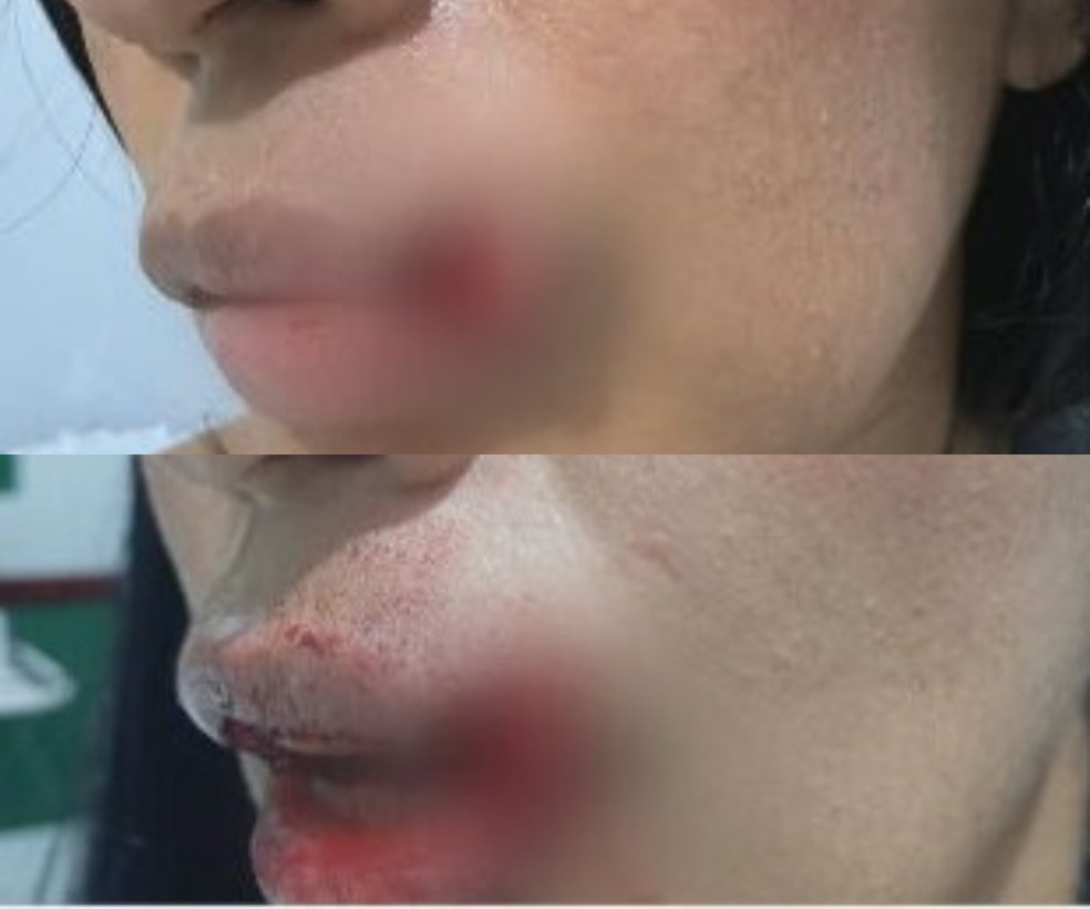 Mulher diz que teve nariz quebrado e boca cortada por ex-marido — Foto: Reprodução