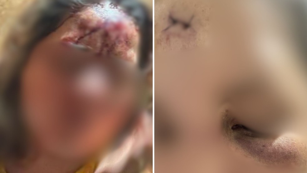Mulher foi agredida pelo namorado e precisou levar pontos na testa, em Santa Helena de Goiás  — Foto: Reprodução / Polícia Civil