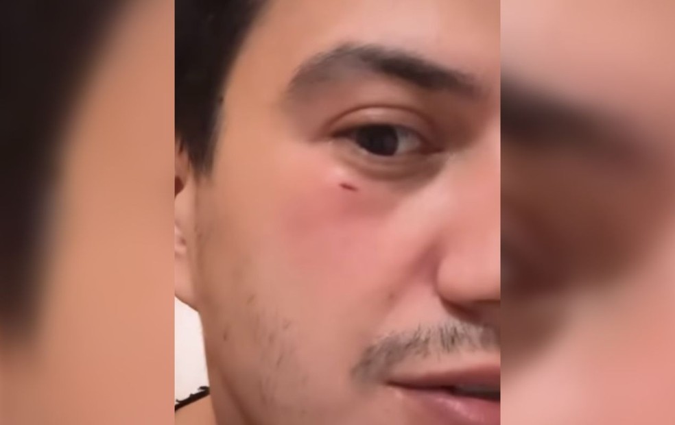 Sertanejo Hugo mostra olho roxo e rosto cortado após fã jogar celular no palco em Ourinhos — Foto: Instagram /Reprodução