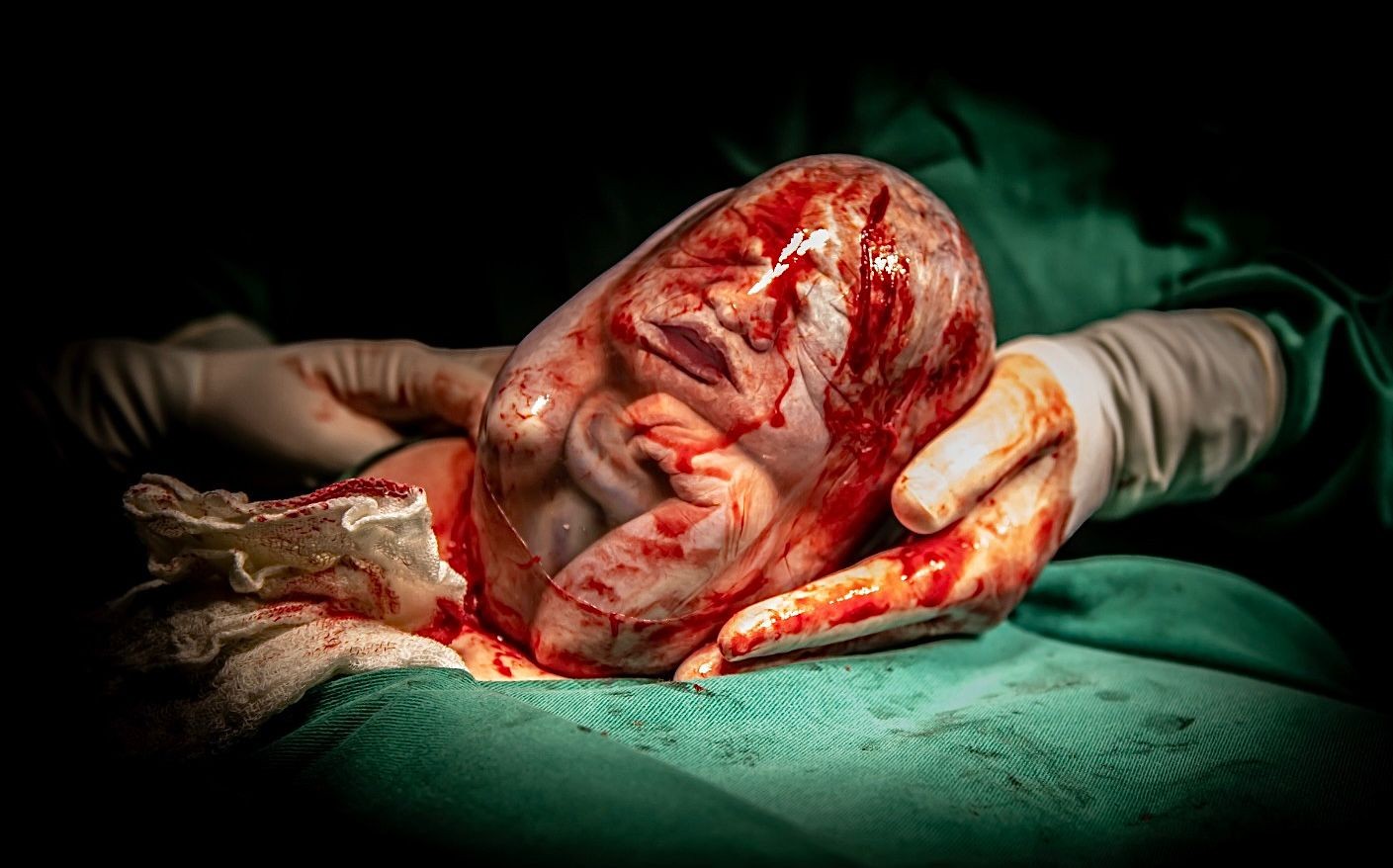 Bebê nasce empelicado fazendo 'pose' com a mãozinha no queixo: 'É extraordinário', diz fotógrafa que registrou o parto