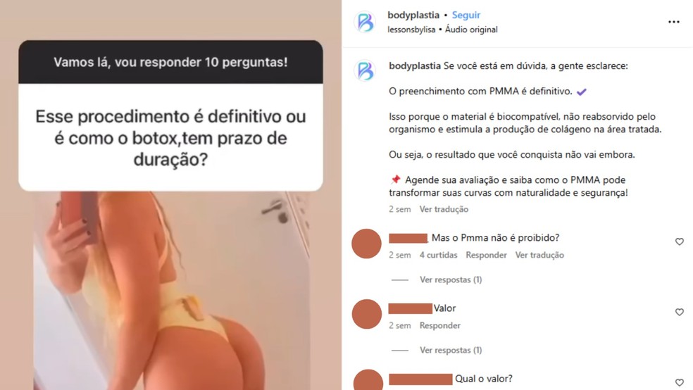 Postagem da clínica no Instagram explica que procedimento com PMMA é definitivo — Foto: Reprodução/Redes sociais