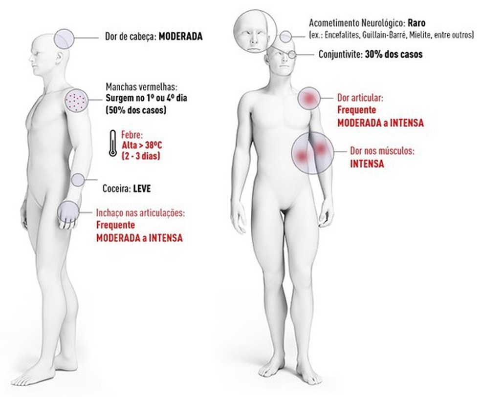 Sintomas da chikungunya  — Foto: Ministério da Saúde