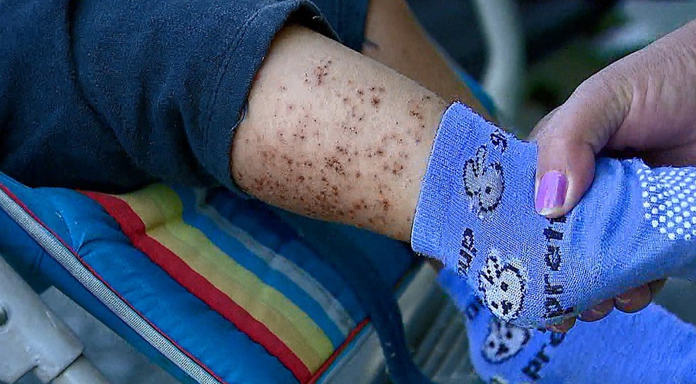 Criança diagnosticada com escarlatina em escola de Lavras se recupera bem em casa, afirmam prefeitura e Ufla — Foto: Acervo EPTV
