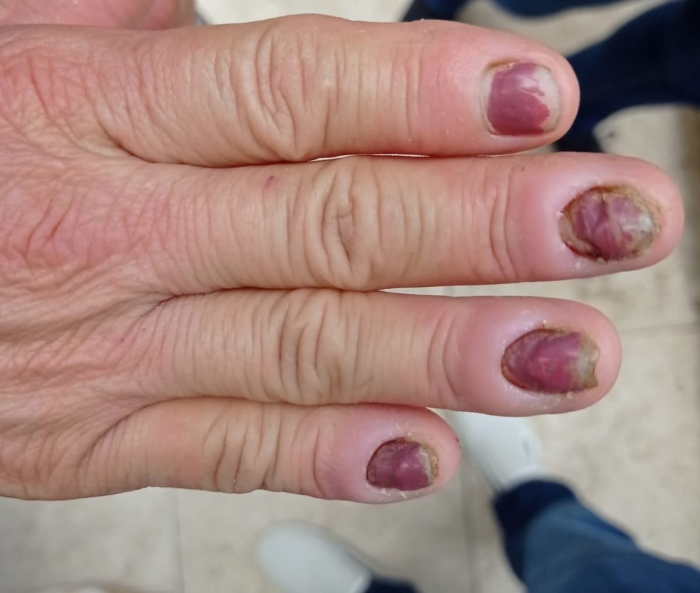 Trabalhadora resgatada mostra problema de saúde nas unhas — Foto: Grupo Especial de Fiscalização Móvel (GEFM)/Divulgação