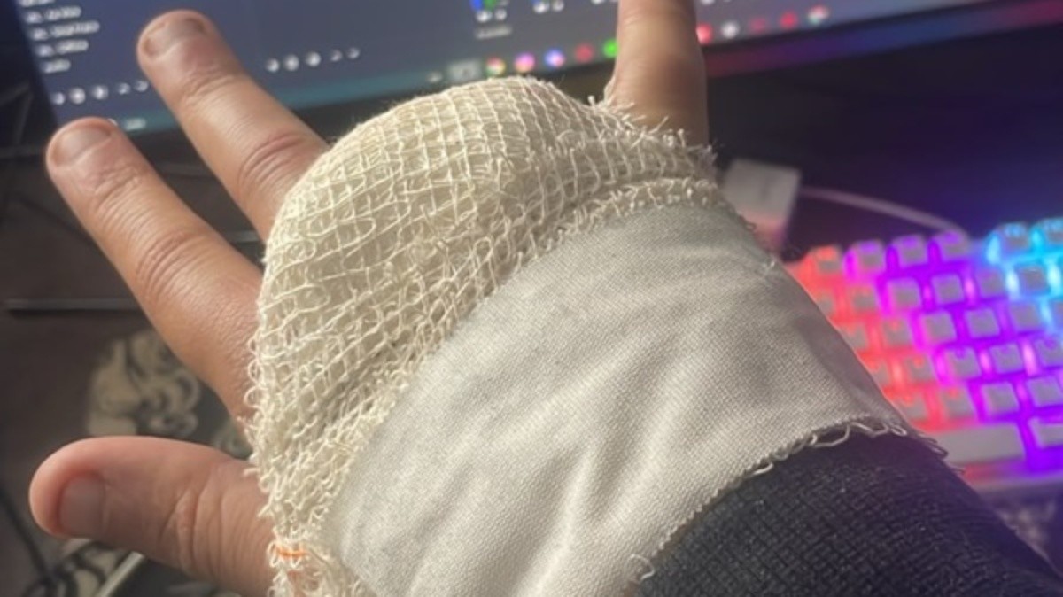 ‘Preferia ter todos os dedos’: streamer se arrepende após perder o anelar em grade do Rock in Rio