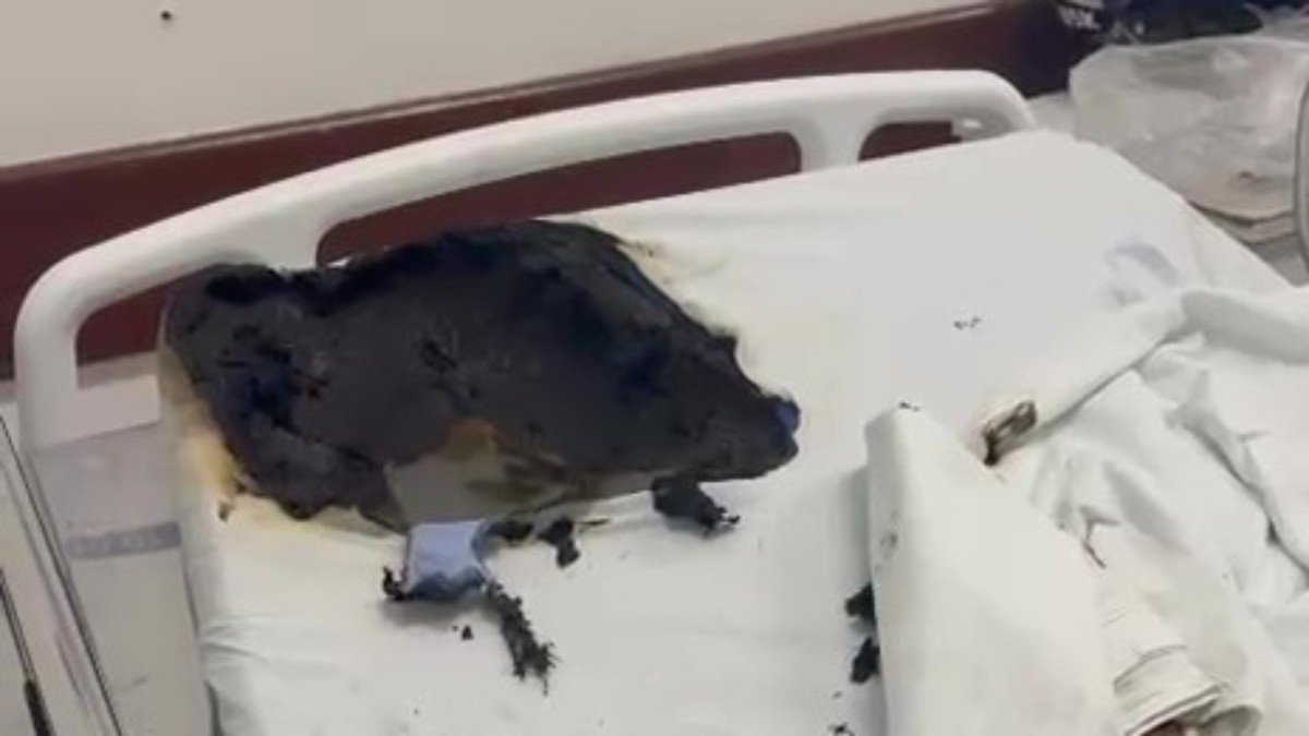 Paciente em surto usa desodorante e isqueiro para atear fogo em outro paciente no Hospital Lourenço Jorge