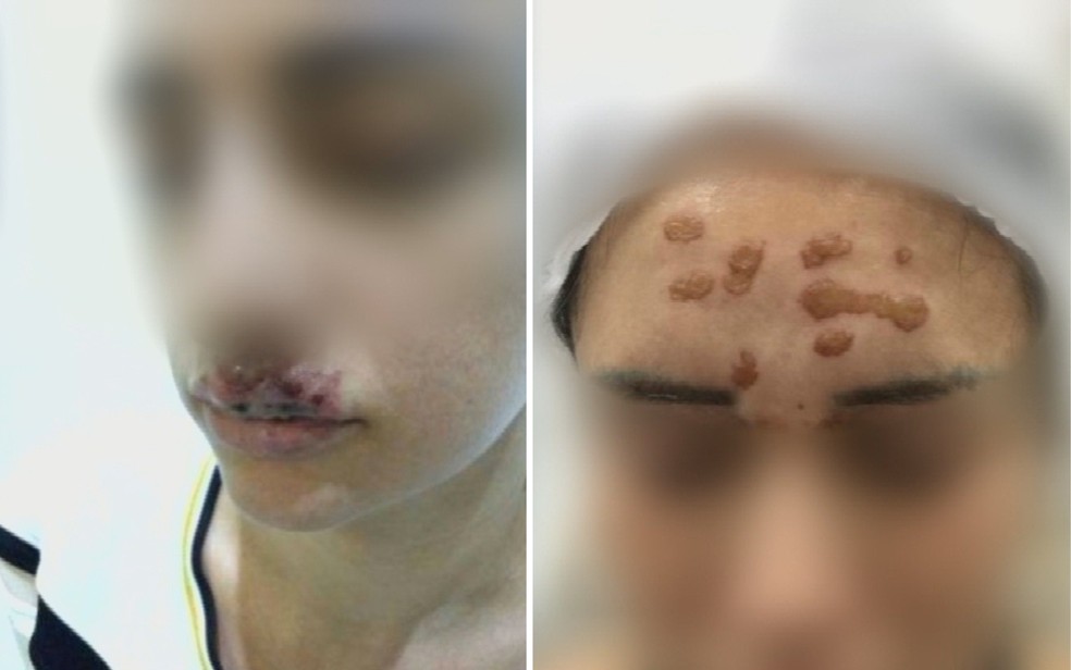 Imagens mostram ferimentos em vítimas de procedimentos estéticos — Foto: Reprodução/TV Anhanguera