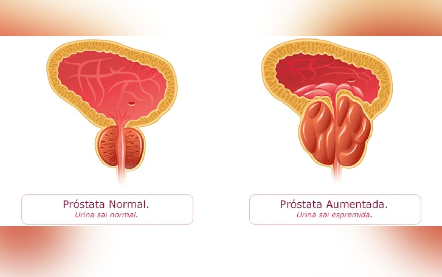 Hiperplasia na próstata: entenda condição que afeta Caiado e milhões de brasileiros