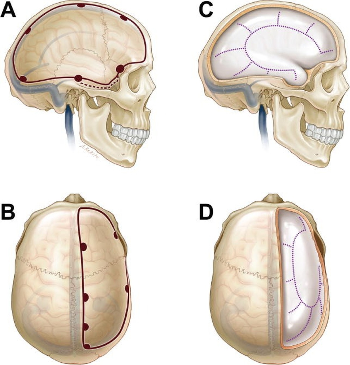 Entenda o que é a craniectomia descompressiva, cirurgia que guarda ...