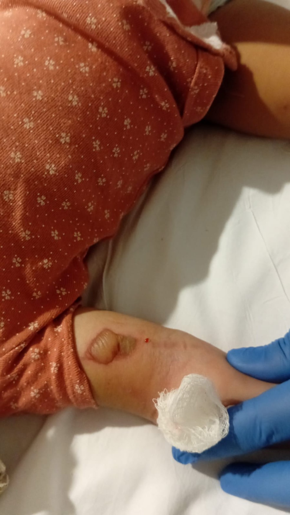 Mãe do bebê registrou a ferida na filha no momento em que uma enfermeira removeu o acesso — Foto: Acervo pessoal/Rayanna Brito