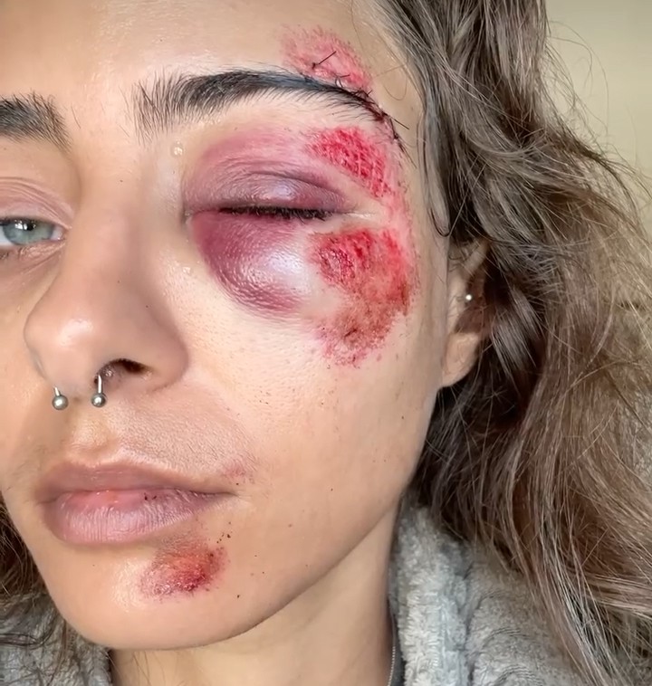 Mulher cai de bicicleta elétrica em buraco em rua de Niterói: ‘Meu rosto foi arrastado no chão’