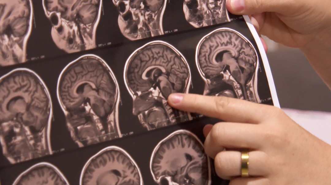 Novo teste pode identificar tipo de tumor cerebral em menos de duas horas e acelerar diagnóstico