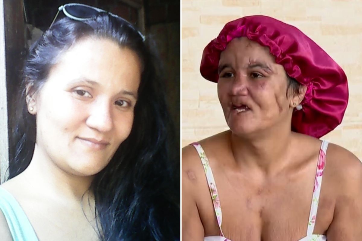 Mulher que teve couro cabeludo e dentes arrancados pelo companheiro busca recomeço: 'Um pouco mais feliz'