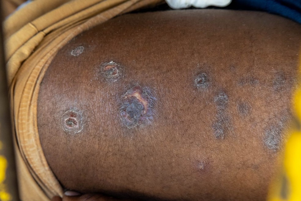 Preso mostra marcas de doen&ccedil;a de pele no bra&ccedil;o em cela do Centro de Deten&ccedil;&atilde;o Provis&oacute;ria II de Osasco, na Grande S&atilde;o Paulo &mdash; Foto: Divulga&ccedil;&atilde;o/Condepe-SP