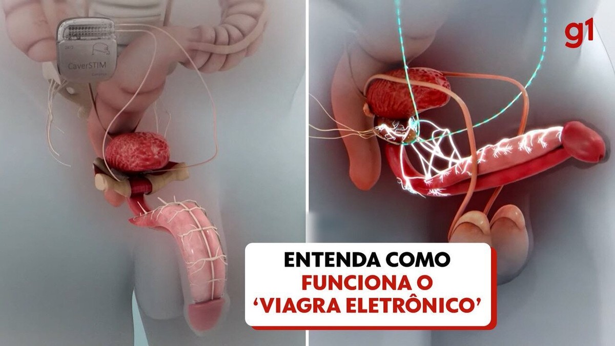 Entenda como funciona ‘viagra eletrônico’, dispositivo contra disfunção  erétil