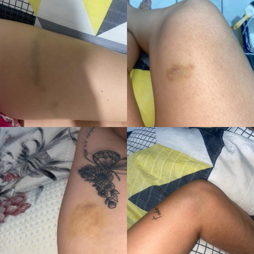 Jovem ficou com vários hermatomas pelo corpo após briga com ex-marido — Foto: Arquivo pessoal