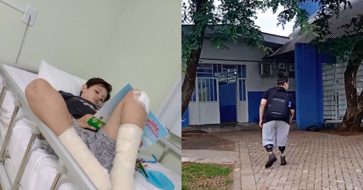 Criança do Paraná se rala após cair de skate, contrai infecção generalizada e precisa amputar as duas pernas: 'Sofreu muito no começo', diz mãe