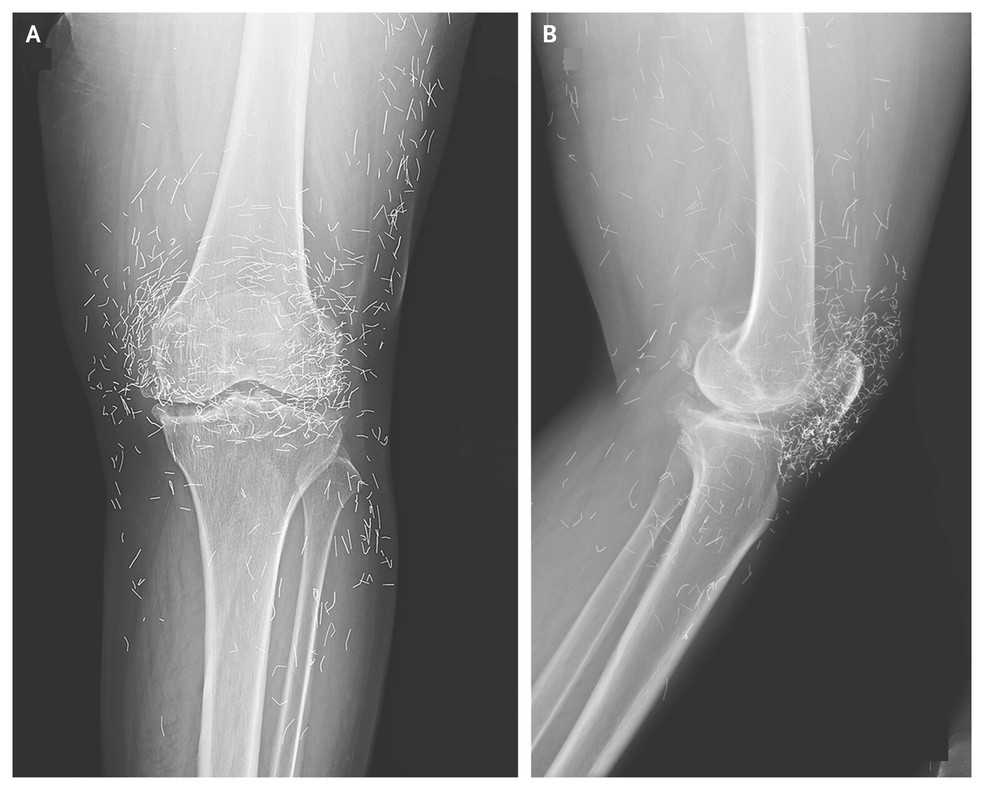 Mulher tem raio-x com pontos brilhantes e médicos descobrem resíduo de acupuntura — Foto: New England Journal of Medicine