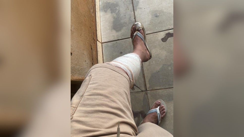 Vítima contou que a dor foi tão forte que achou que tivesse quebrado a perna — Foto: Reprodução/Arquivo Pessoal