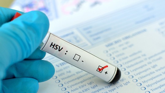 Herpes genital: o que é, sintomas e como tratar - Infecção causada por vírus, o herpes genital não tem cura, mas pode ser controlado com antivirais. Veja sintomas, formas de contágio e como se proteger.