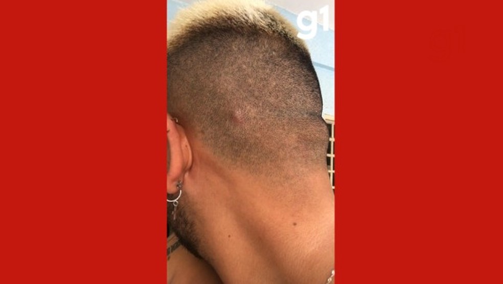 Pequeno caroço no couro cabeludo, que levou Ivann a descobrir a doença — Foto: Reprodução