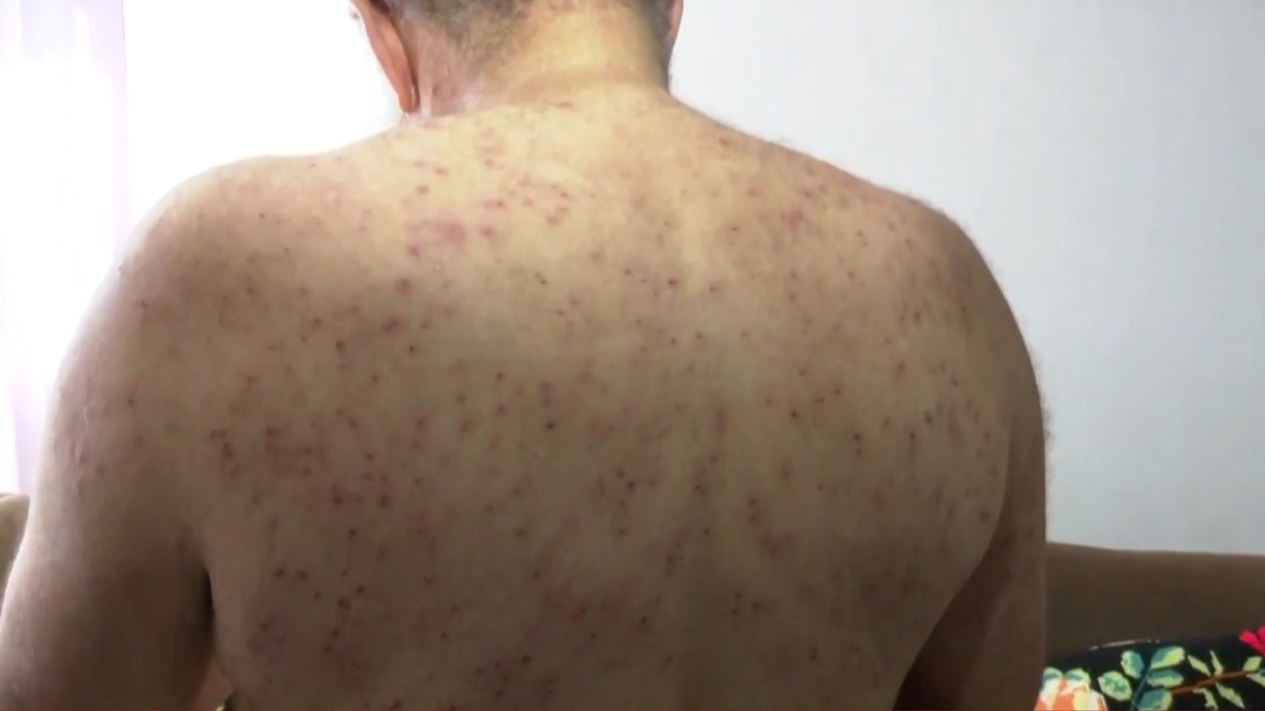 Homem de 68 anos que sobreviveu a mil picadas de abelha no PR mostra marcas das ferroadas: ‘Eu creio que é um milagre’