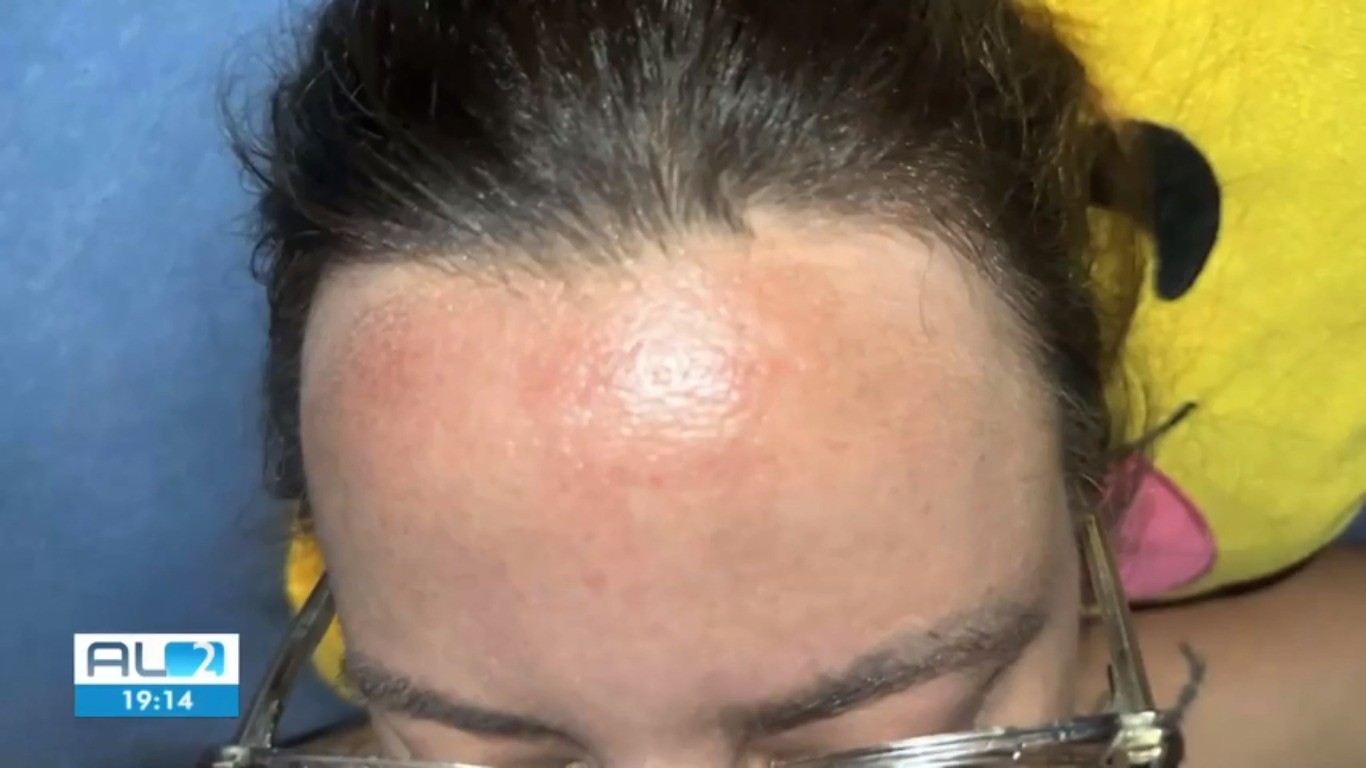 'Associei ao calor', diz maquiadora com queimadura na testa após unção com óleo em igreja em Maceió