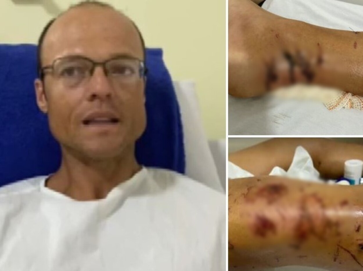 Quatro são condenados a indenizar em R$ 158,1 mil triatleta que levou mais de 50 mordidas de pitbulls