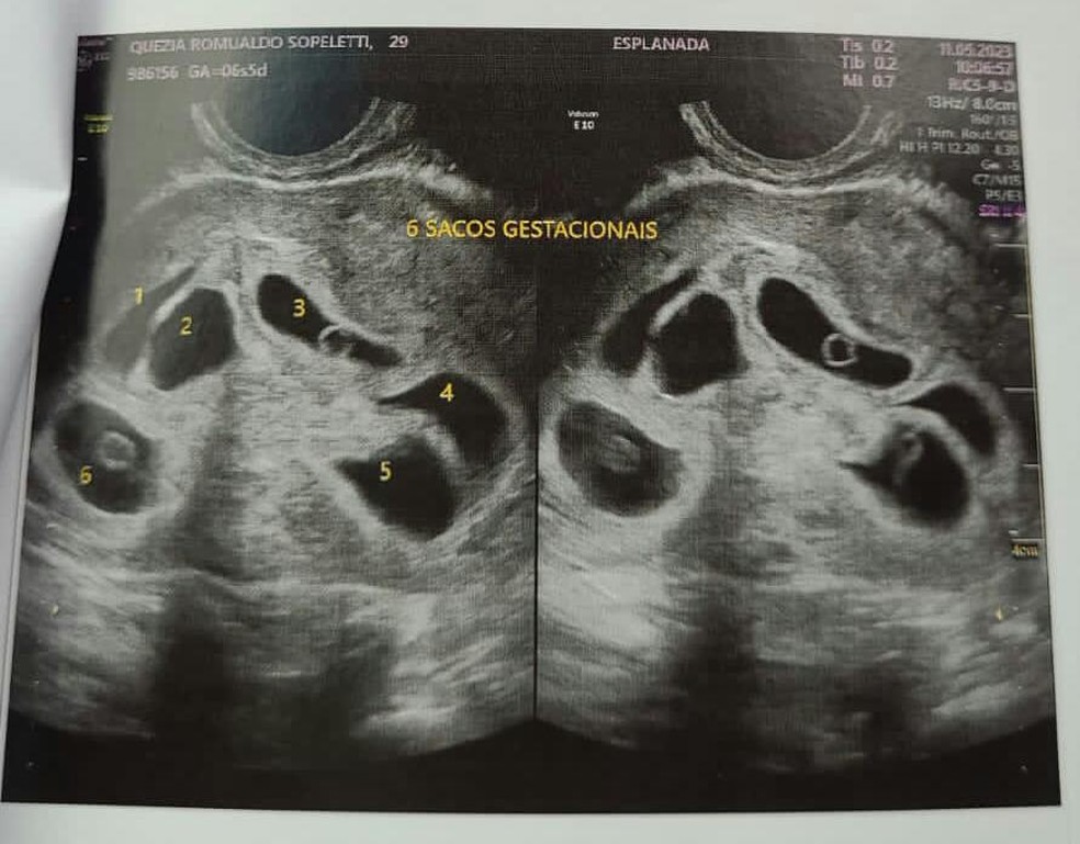 Ultrassom de Quezia que mostra os seis bebês — Foto: Reprodução/Acervo pessoal