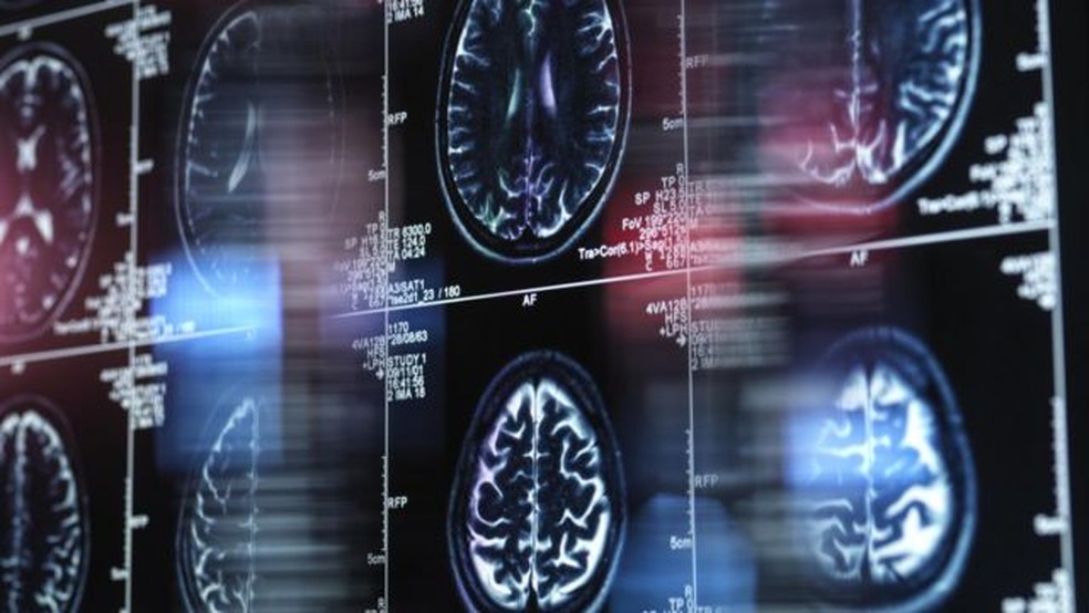 É possível ter Alzheimer com 19 anos?