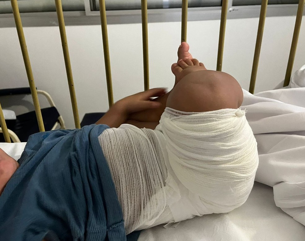 Bebê segue internado no hospital em Bauru com queimaduras — Foto: Arquivo pessoal
