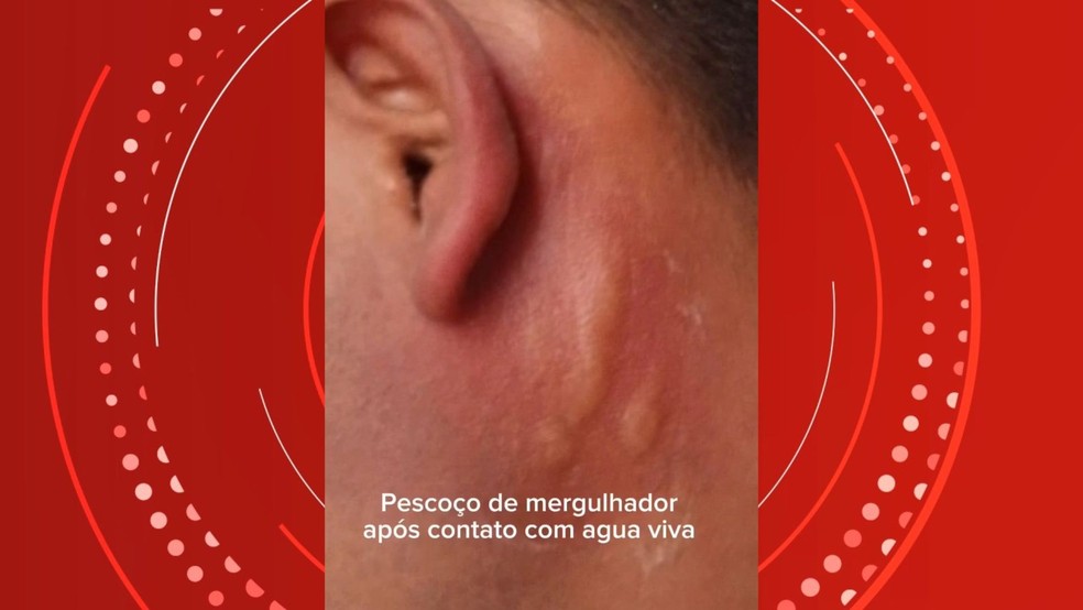 Médico veterinário, Enzo Bernardes Favaro, fez registros de amigo com queimadura de água-viva no pescoço. Espírito Santo — Foto: Enzo Bernardes Favaro