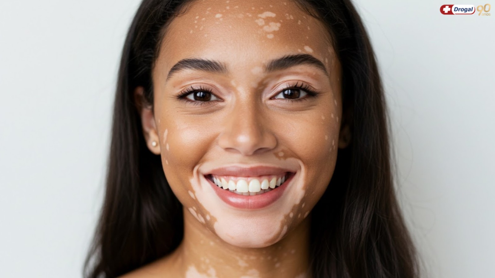 Tipos de vitiligo: entenda quais existem e como identificar