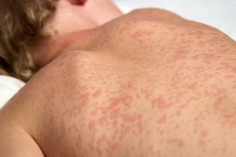 Com surto de sarampo na Bolívia, Mato Grosso do Sul antecipou aplicação da “dose zero” em bebês. — Foto: Reprodução