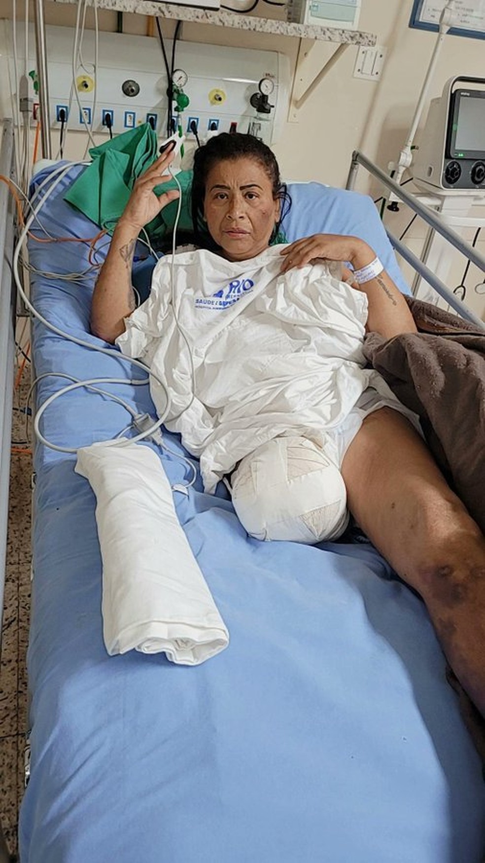 MC Katia, logo após a amputação da perna — Foto: Reprodução/Redes sociais