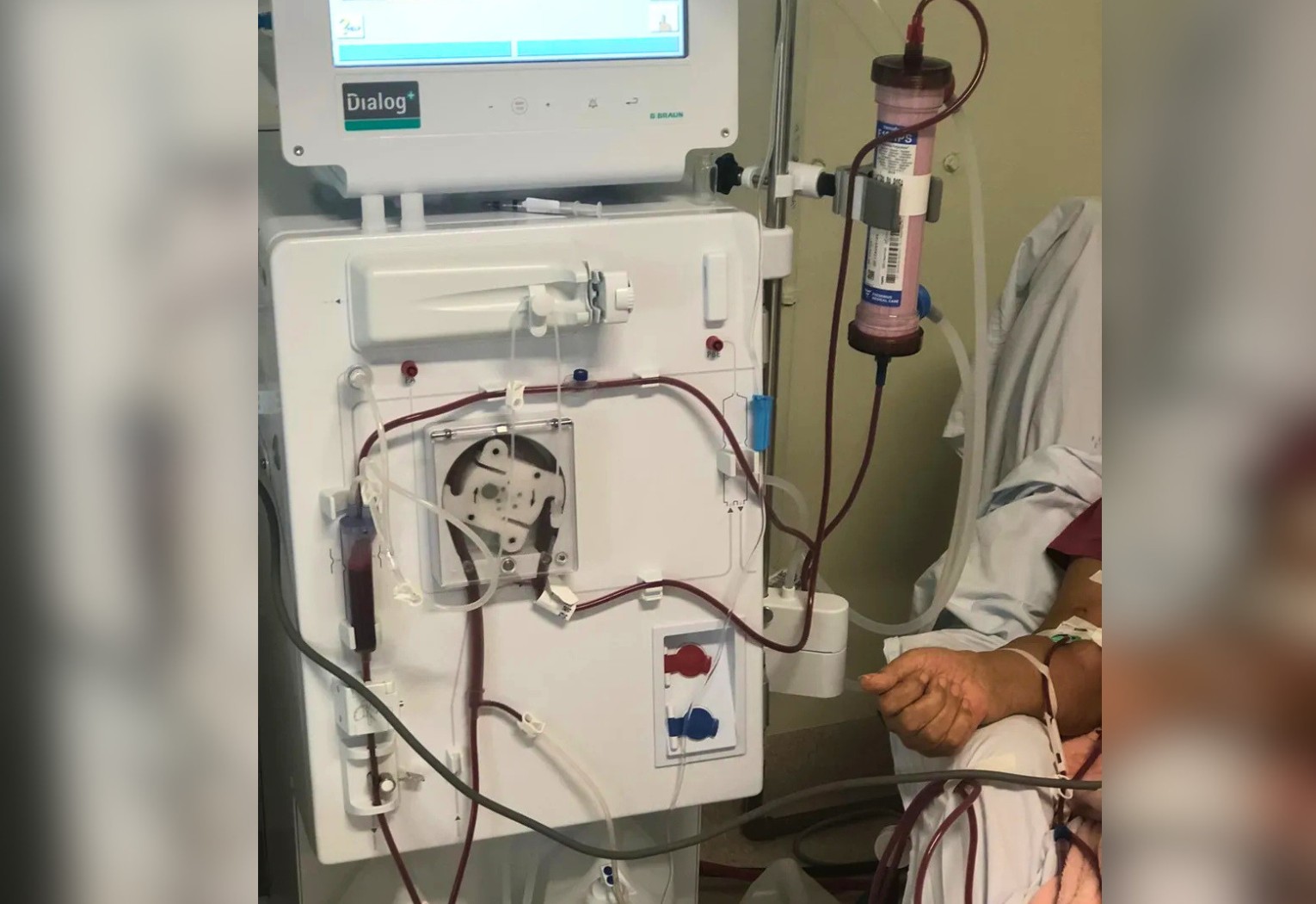 Pacientes renais do TO que aguardam transplante relatam dificuldades para conseguir passagens aéreas pelo Estado