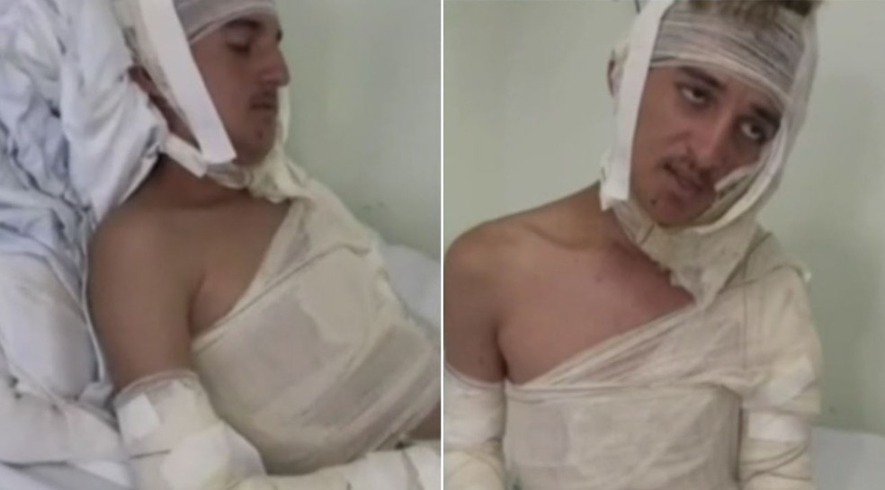 Jovem teve queimaduras de segundo e terceiro grau no rosto, peito, braços e nas costas. — Foto: Reprodução/TV Verdes Mares