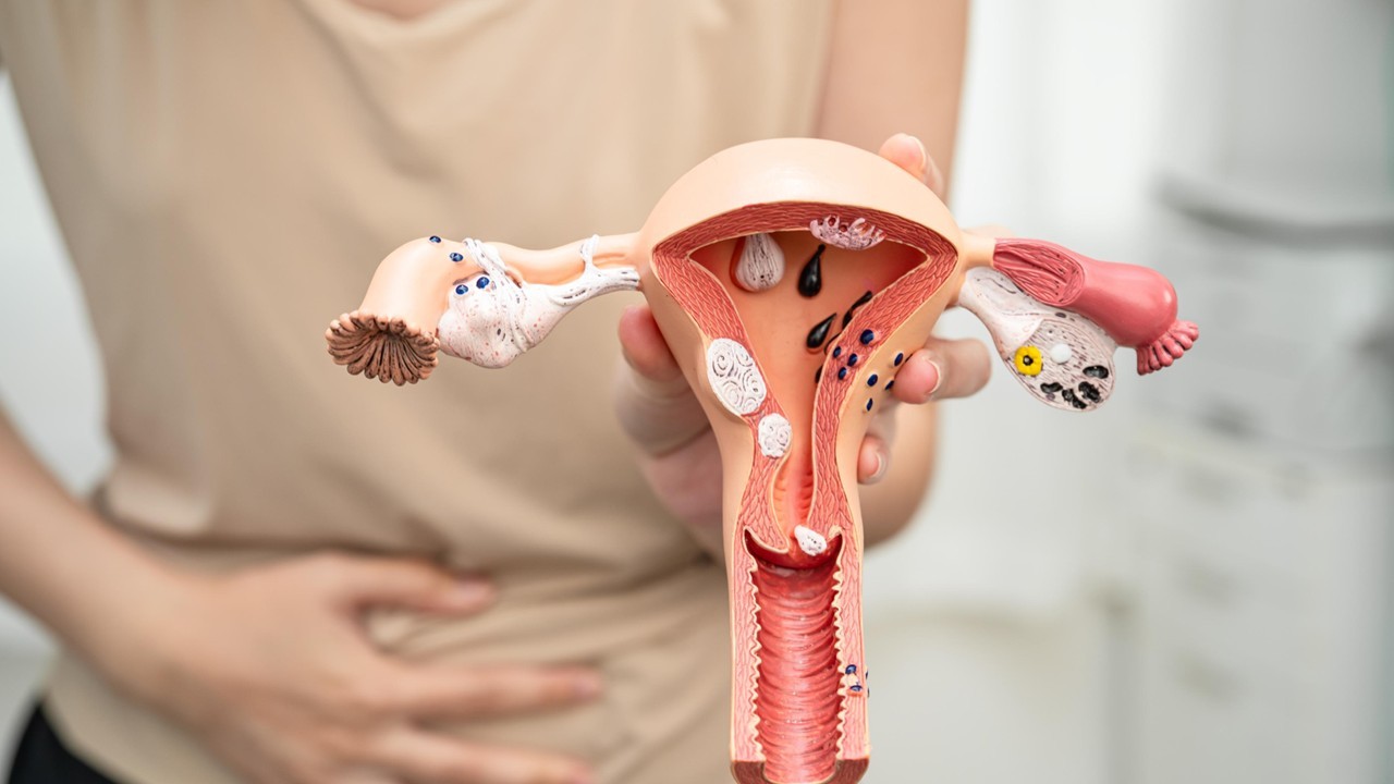 Endometriose: doença ignorada por séculos já tinha sintomas descritos na Antiguidade