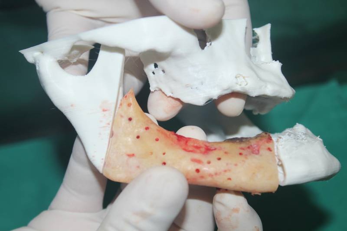 Tecnologia 3D Revoluciona Cirurgia: Homem de 65 Anos Reconstrói Rosto em Belém