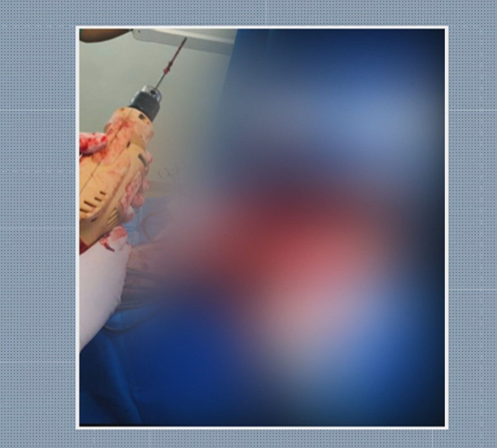Mdicos do Hospital Pari, Centro de SP, usam furadeiras domsticas em cirurgias ortopdicas — Foto: TV Globo